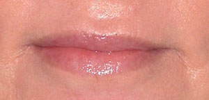 Lip Augmentation - Patient 6 - After